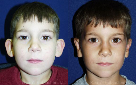 patient-12956-otoplasty-before-after