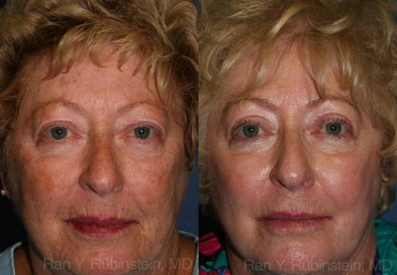 Before: Significant sun damage including uneven skin tone and color. Patient didn?t want more aggressive laser resurfacing.
After: TCA peel, a medium depth peel, with dramatic results and less downtime than laser resurfacing.