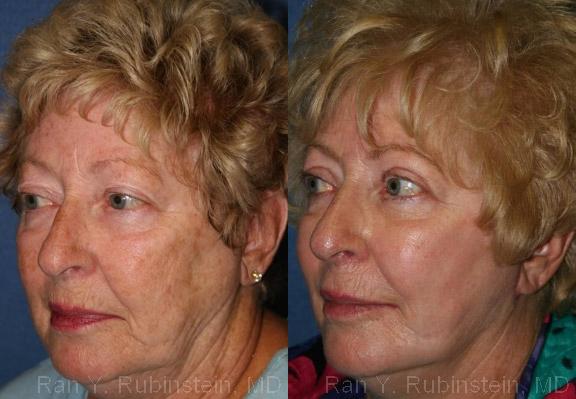 Before: Significant sun damage including uneven skin tone and color. Patient didn?t want more aggressive laser resurfacing.
After: TCA peel, a medium depth peel, with dramatic results and less downtime than laser resurfacing.
