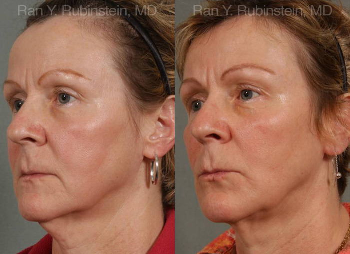 patient-13265-laser-lift-precision-tx-before-after