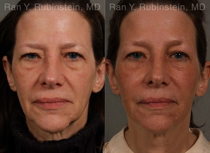 patient-17263-injectable-fillers-before-after-scaled
