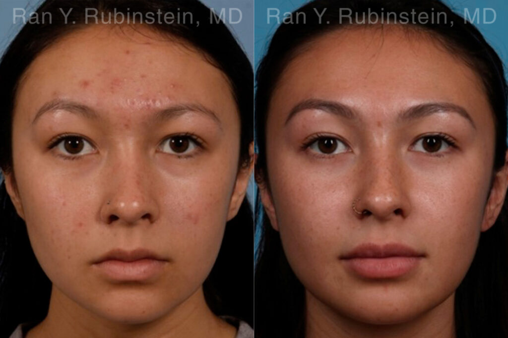 Hydrafacial Before and After