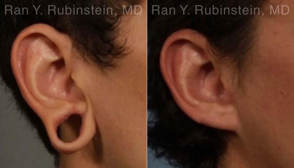 Before: 27-year-old with gauged earring regret concerned that repair will result in an unnatural appearance
After: 3 years after ear lobe reconstruction. Patient’s earlobe is pleased with how natural his earlobe appears and is very close to his original shape.