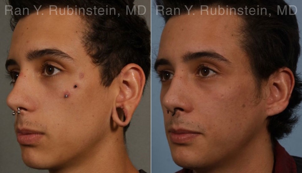 patient-19161-earlobe-repair-before-after