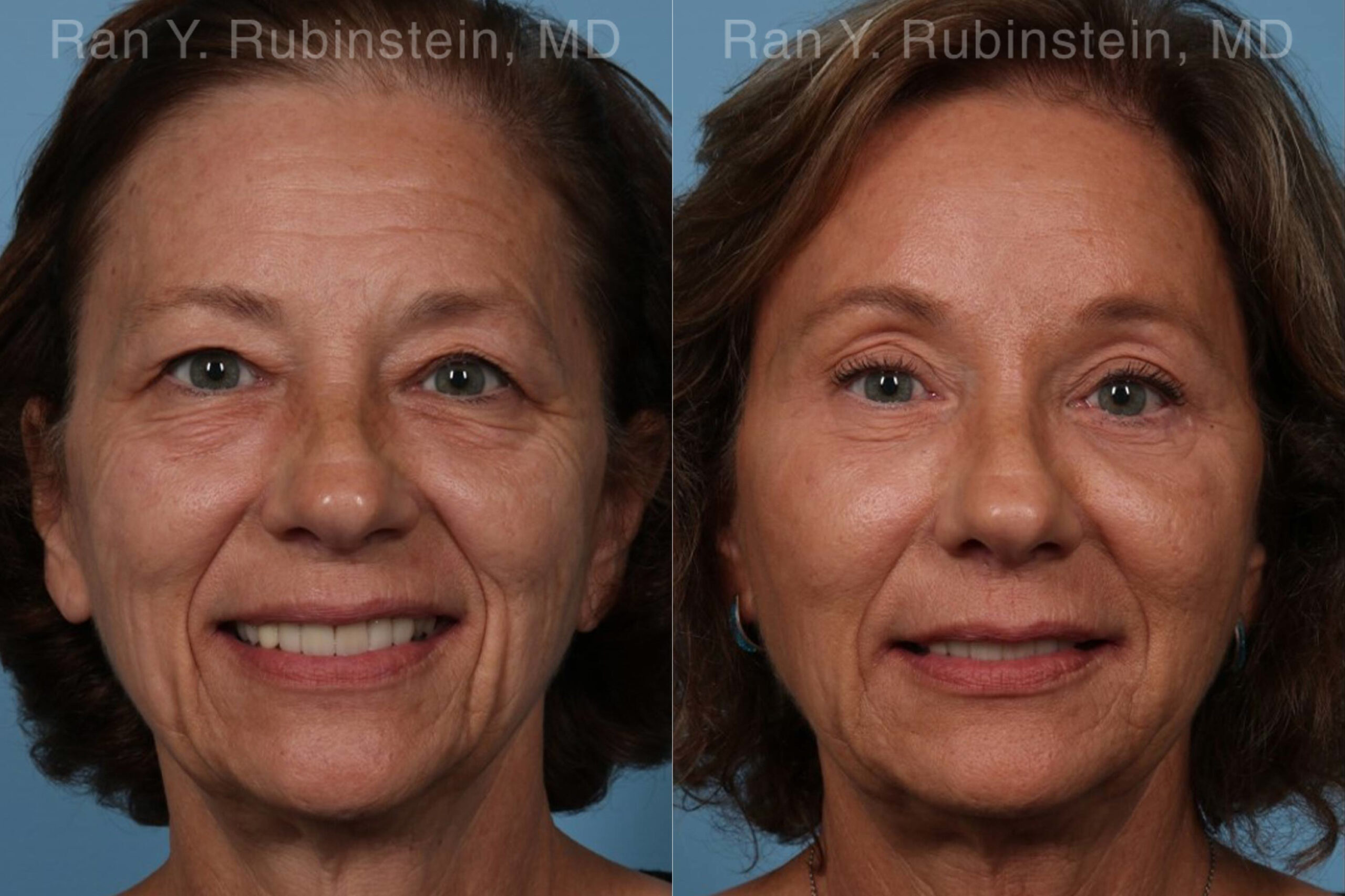 patient-19743-brow-lift-before-after-1