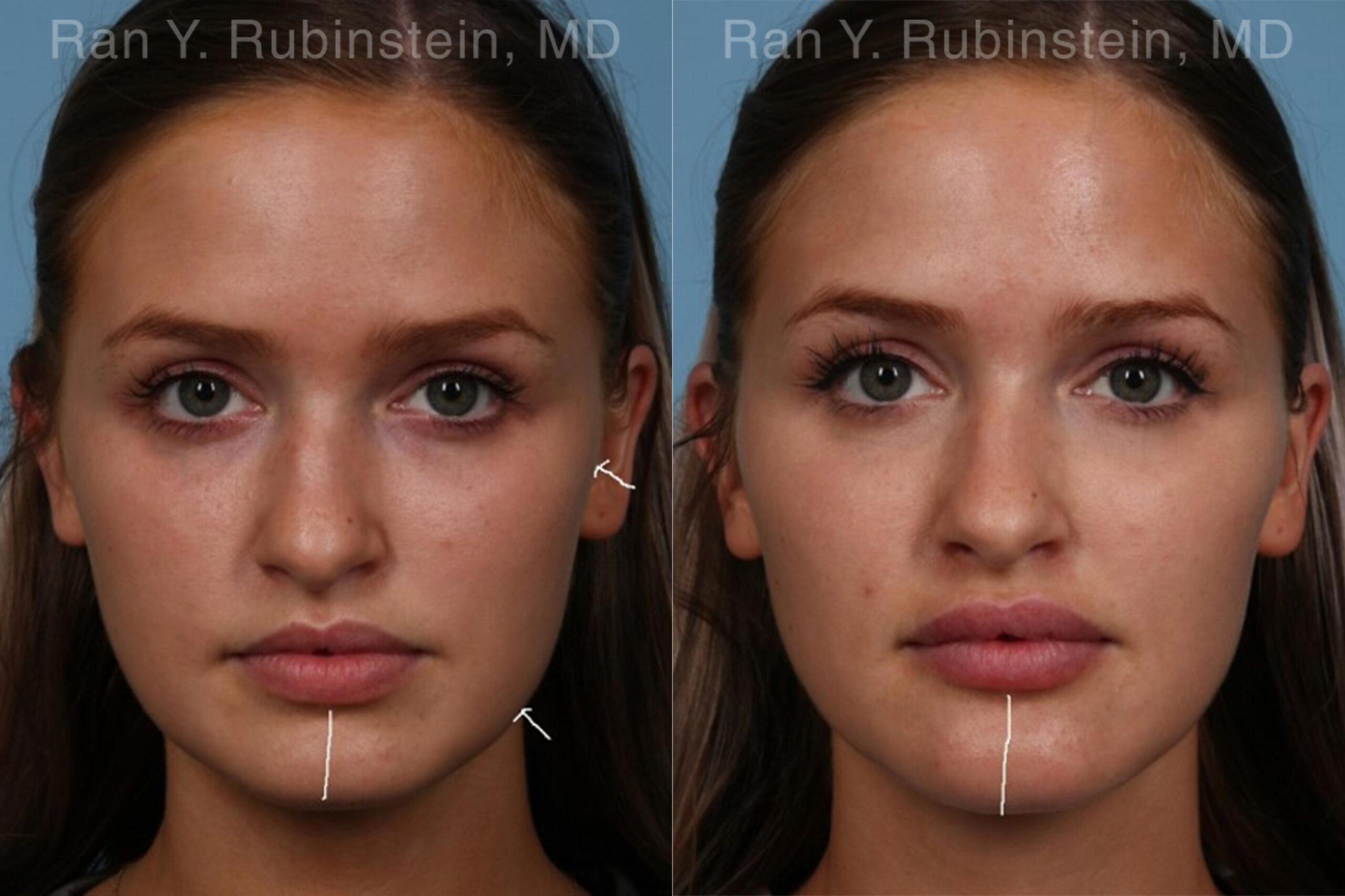 patient-19839-chin-filler-before-after