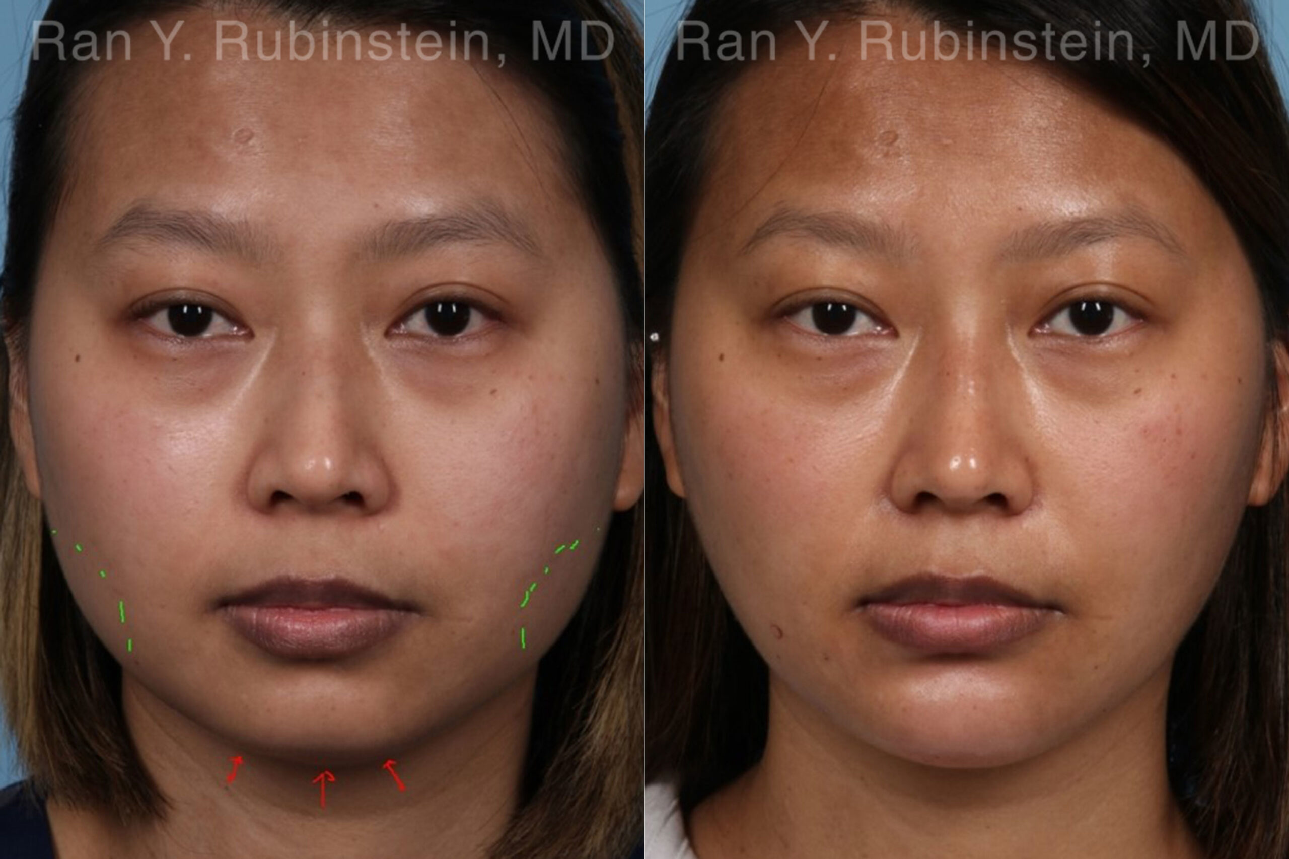 patient-19961-chin-filler-before-after