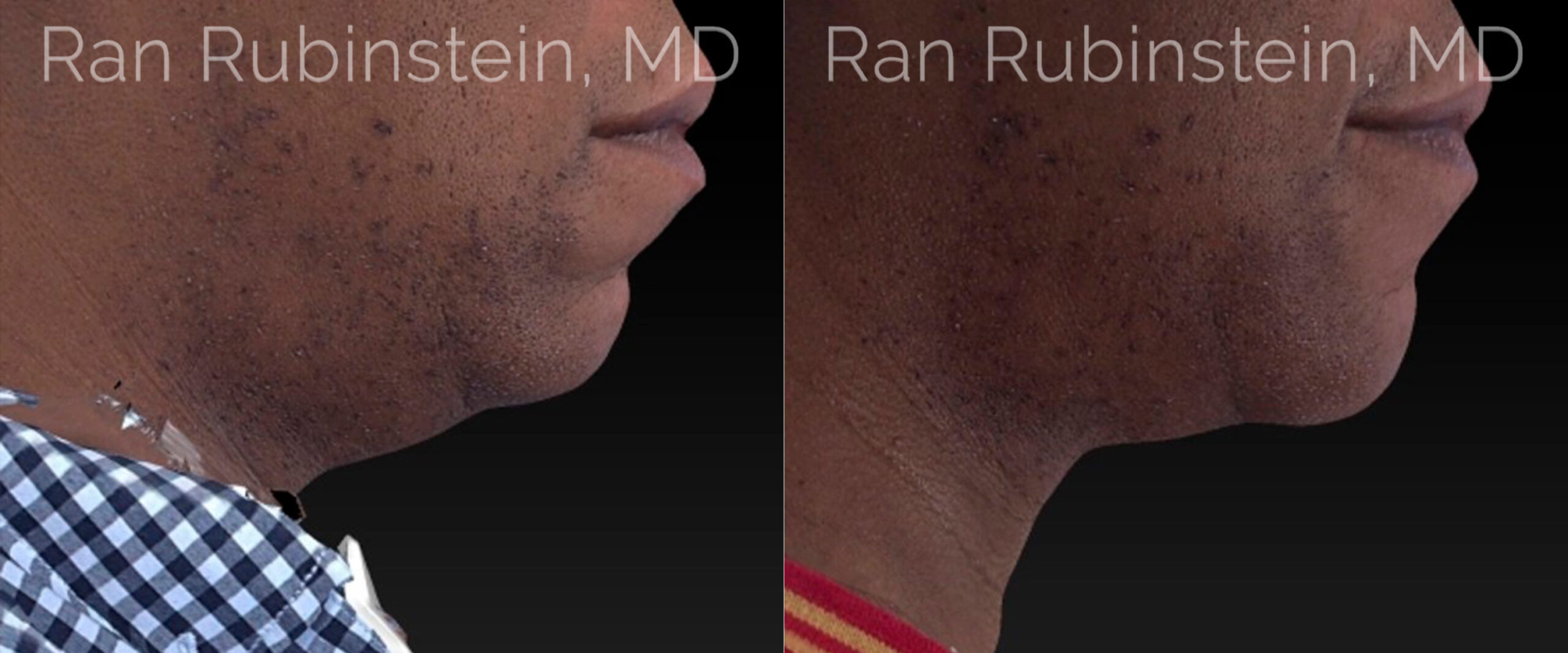 patient-20743-chin-filler-before-after