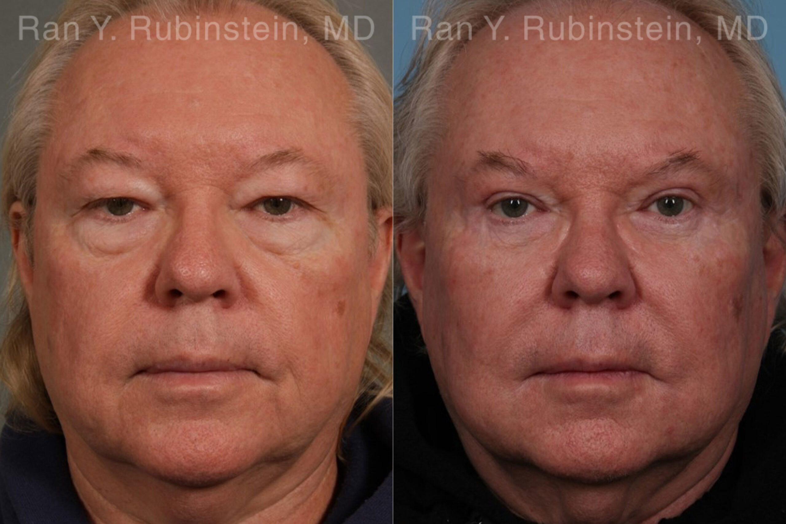patient-21152-eyelid-surgery-before-after