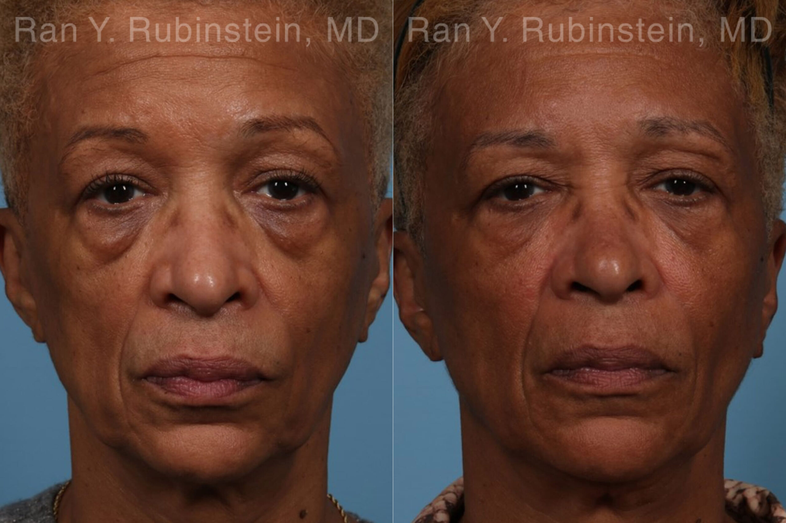 patient-21755-sculptra-face-before-after