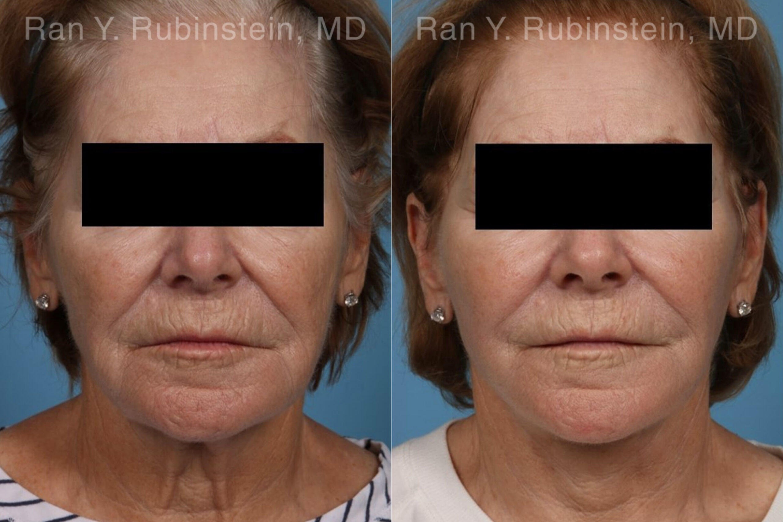 patient-21942-face-lift-neck-lift-before-after