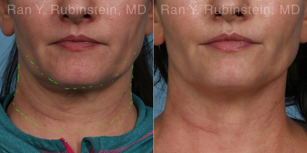 patient-21952-genius-fractionated-rf-before-after