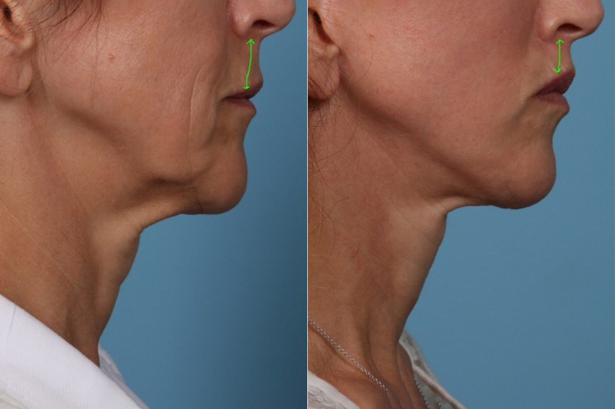 patient-22196-lip-lift-before-after