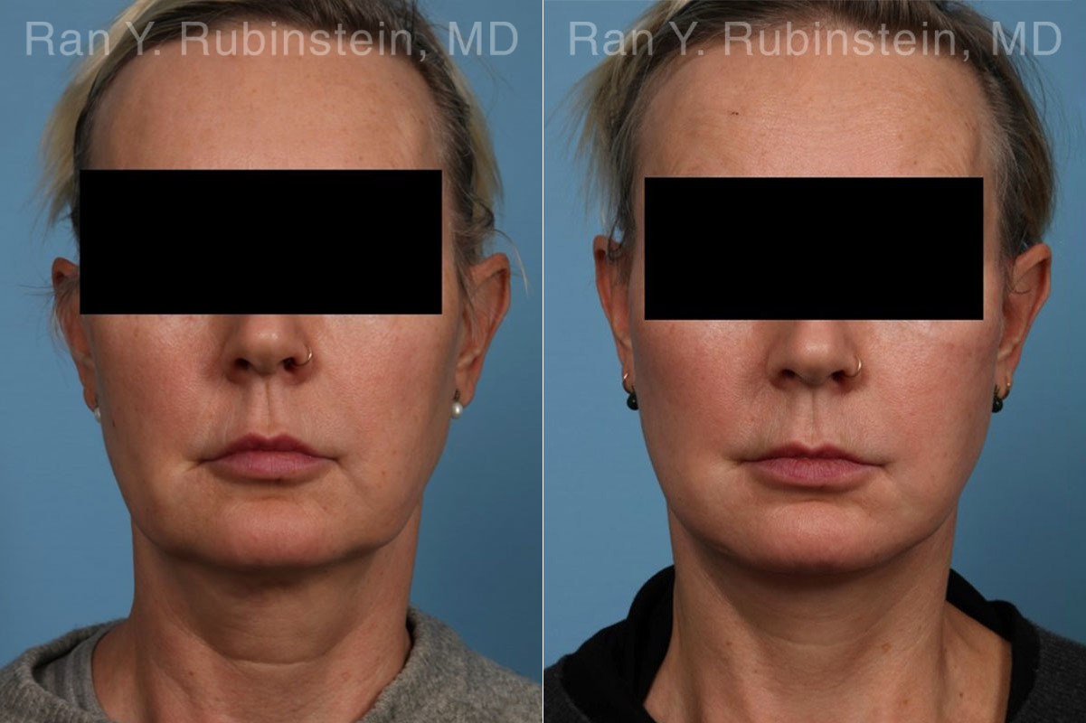 patient-22249-face-lift-neck-lift-before-after-2