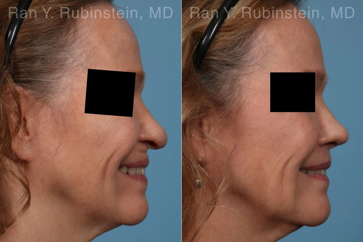 patient-22260-lip-lift-before-after-2