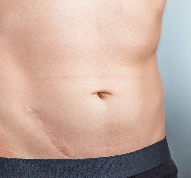 Scars can negatively impact one’s self-esteem, particularly when located on visible areas like the face.