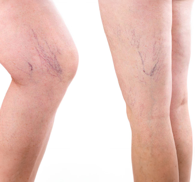 Leg with Spider Veins