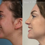 Rhinoplasty Before and After Photos in Montvale, NJ, Patient 26514