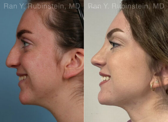 Rhinoplasty Before and After Photos in Montvale, NJ, Patient 26514