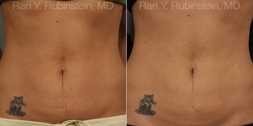 patient-13207-skin-tightening-before-after