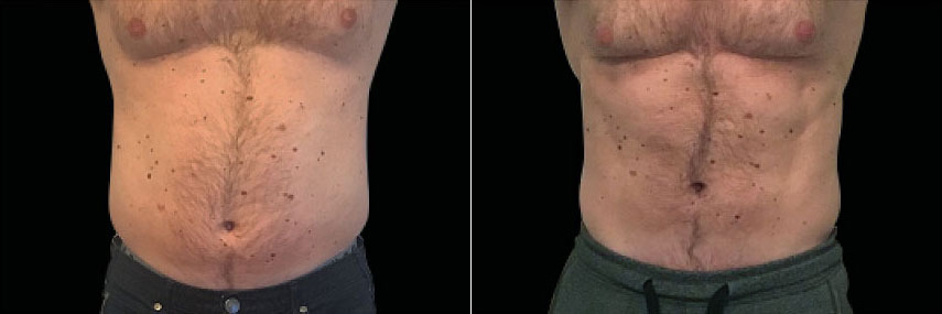 patient-23537-emsculpt-before-after