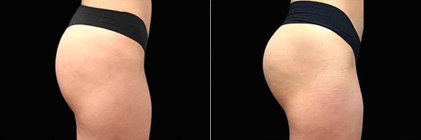 patient-23541-emsculpt-before-after