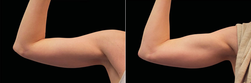 patient-23545-emsculpt-before-after