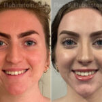 Rhinoplasty Before and After Photos in Montvale, NJ, Patient 26514