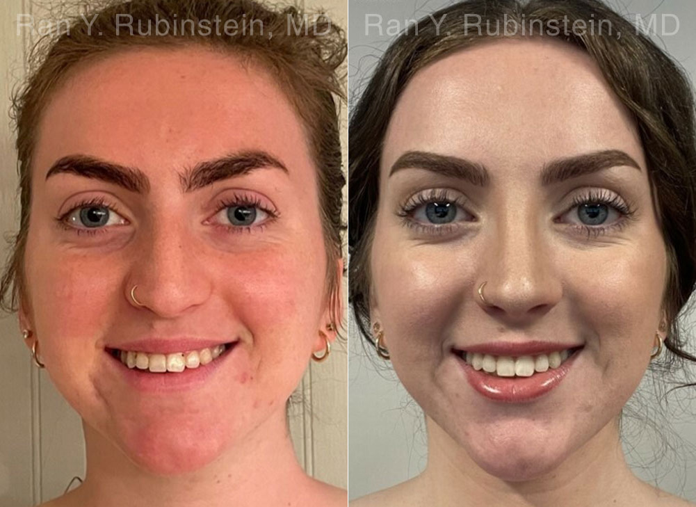 Rhinoplasty Before and After Photos in Montvale, NJ, Patient 26514
