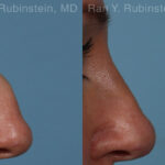 Non-Surgical Rhinoplasty Before and After Photos in Montvale, NJ, Patient 26523