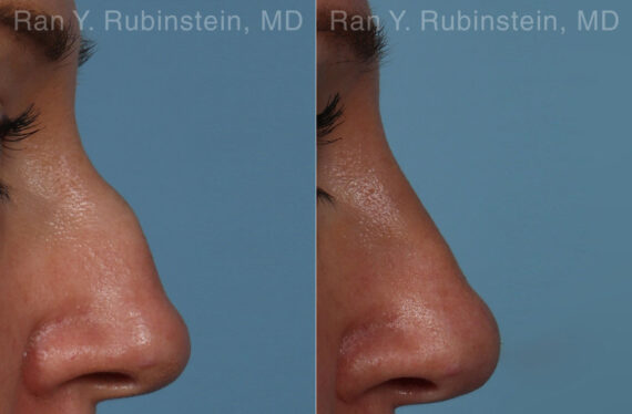 Non-Surgical Rhinoplasty Before and After Photos in Montvale, NJ, Patient 26523