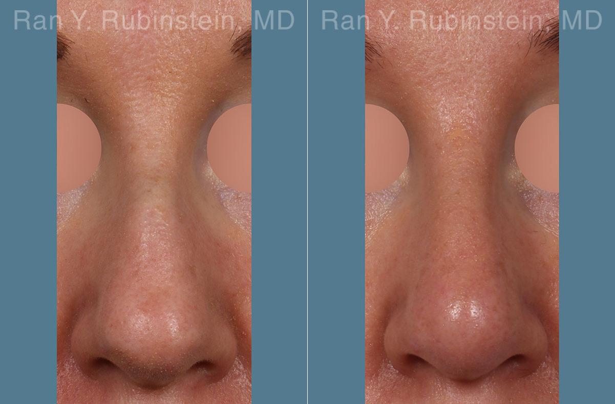 Non-Surgical Rhinoplasty Before and After Photos in Montvale, NJ, Patient 26523