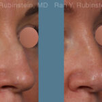 Non-Surgical Rhinoplasty Before and After Photos in Montvale, NJ, Patient 26523