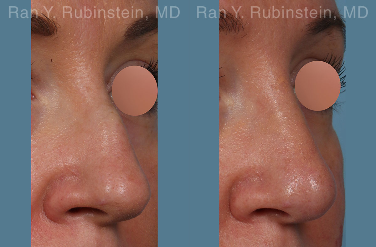 Non-Surgical Rhinoplasty Before and After Photos in Montvale, NJ, Patient 26523