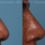 Non-Surgical Rhinoplasty Before and After Photos in Montvale, NJ, Patient 26533