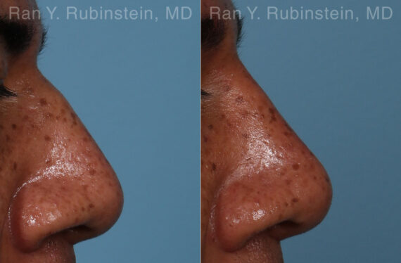 Non-Surgical Rhinoplasty Before and After Photos in Montvale, NJ, Patient 26533