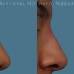 Non-Surgical Rhinoplasty Before and After Photos in Montvale, NJ, Patient 26560