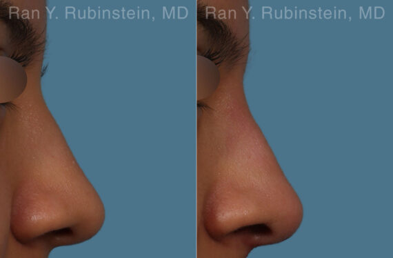 Non-Surgical Rhinoplasty Before and After Photos in Montvale, NJ, Patient 26560