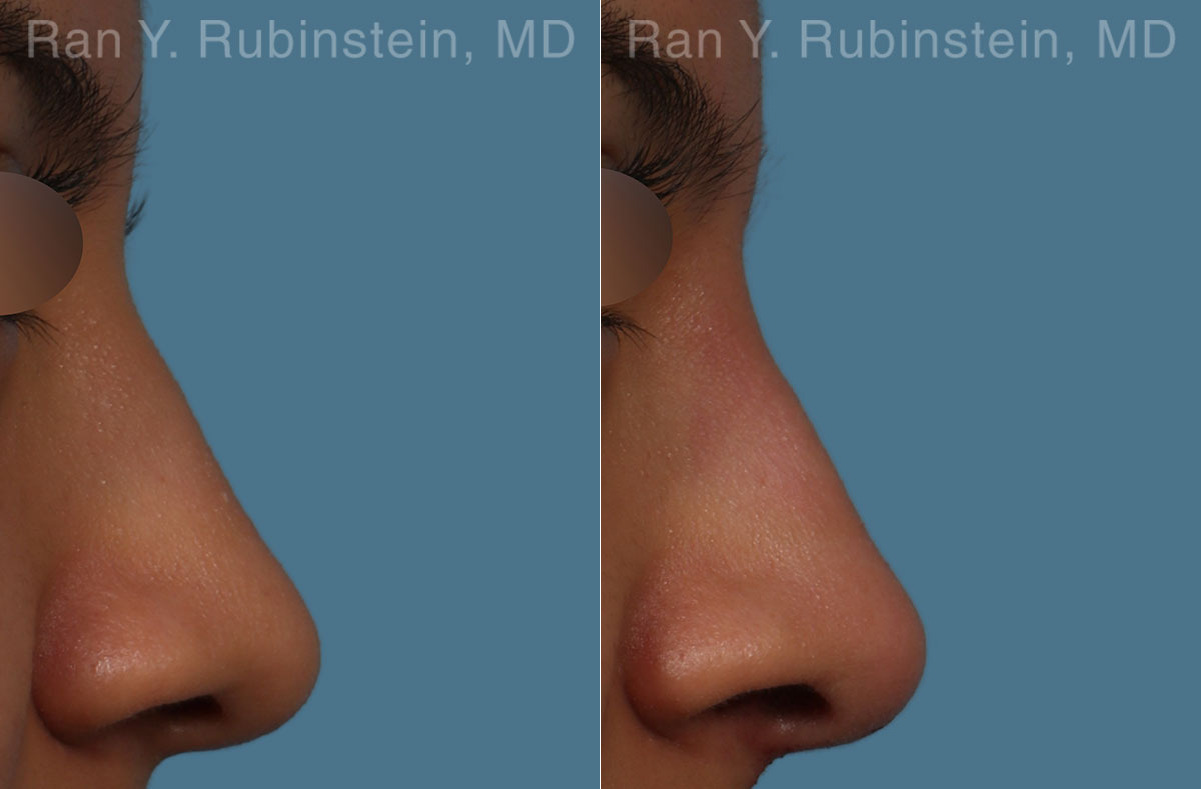 Non-Surgical Rhinoplasty Before and After Photos in Montvale, NJ, Patient 26560