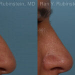 Non-Surgical Rhinoplasty Before and After Photos in Montvale, NJ, Patient 26566