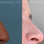 Non-Surgical Rhinoplasty Before and After Photos in Montvale, NJ, Patient 26566