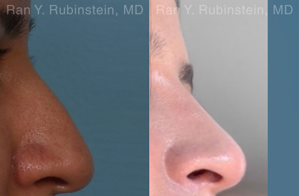 Non-Surgical Rhinoplasty Before and After Photos in Montvale, NJ, Patient 26566