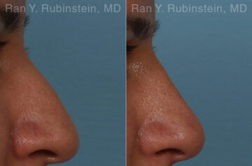 Non-Surgical Rhinoplasty Before and After Photos in Montvale, NJ, Patient 26566
