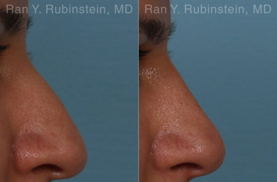 Non-Surgical Rhinoplasty Before and After Photos in Montvale, NJ, Patient 26566
