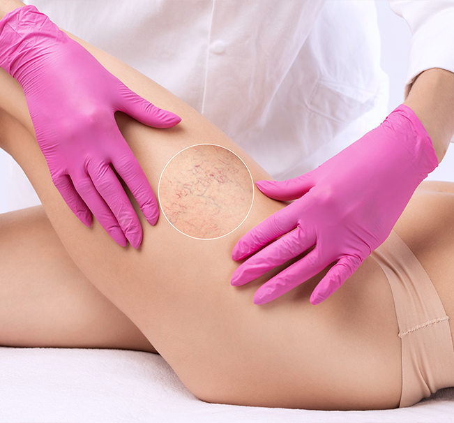 Spider vein laser therapy is an advanced, non-invasive treatment designed to reduce the appearance of spider veins on the skin