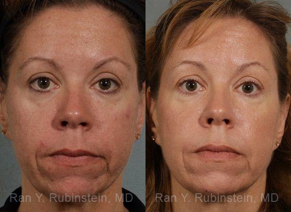 Before: Acne scars, large pores, coarse skin, mild to moderate wrinkles.
After: A series of 4 Fraxel Dual 1550 and Fraxel Dual 1927 laser treatments.