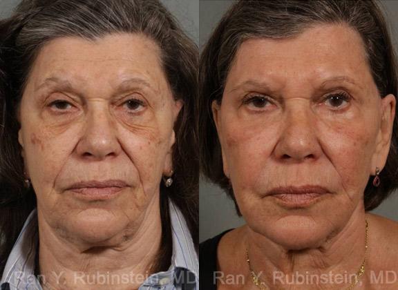 Before: Deflation of face with sagging skin in 77 year old patient who doesn’t want surgical intervention. Also has age spots and deep wrinkles.
After: Fraxel Repair laser was used to treat her deep wrinkles and tighten her skin along her jaw line and neck. Fraxel Dual 1927 two treatments to further improve her skin tone and texture. Volume restoration in her face and jaw line has had an uplifting effect. In addition, 4 Sculptra treatments were used. Results need to be touched up every two years