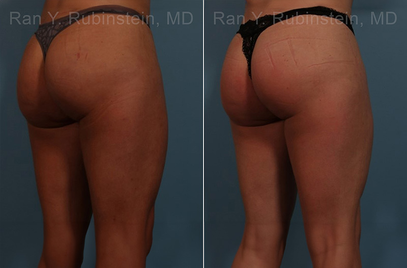 patient-sculptra-butt-lift-before-after-2