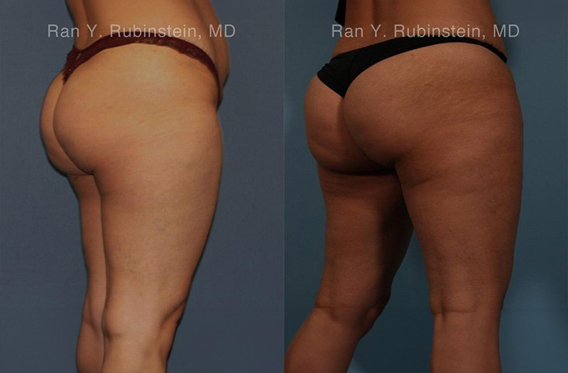 patient-sculptra-butt-lift-before-after-3