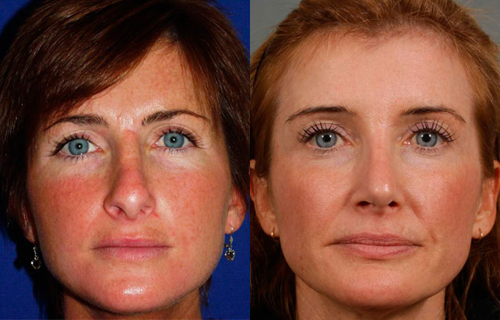 vicki-before-after-01